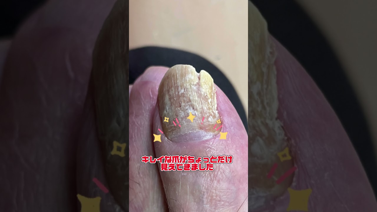 爪水虫、飲み薬ネイリンでここまで治りました！ #爪白癬 #爪水虫 #ネイリン #皮膚科 #美容皮膚科 #こはく皮フ科クリニック #こはく皮膚科クリニック #豊田市に開業予定