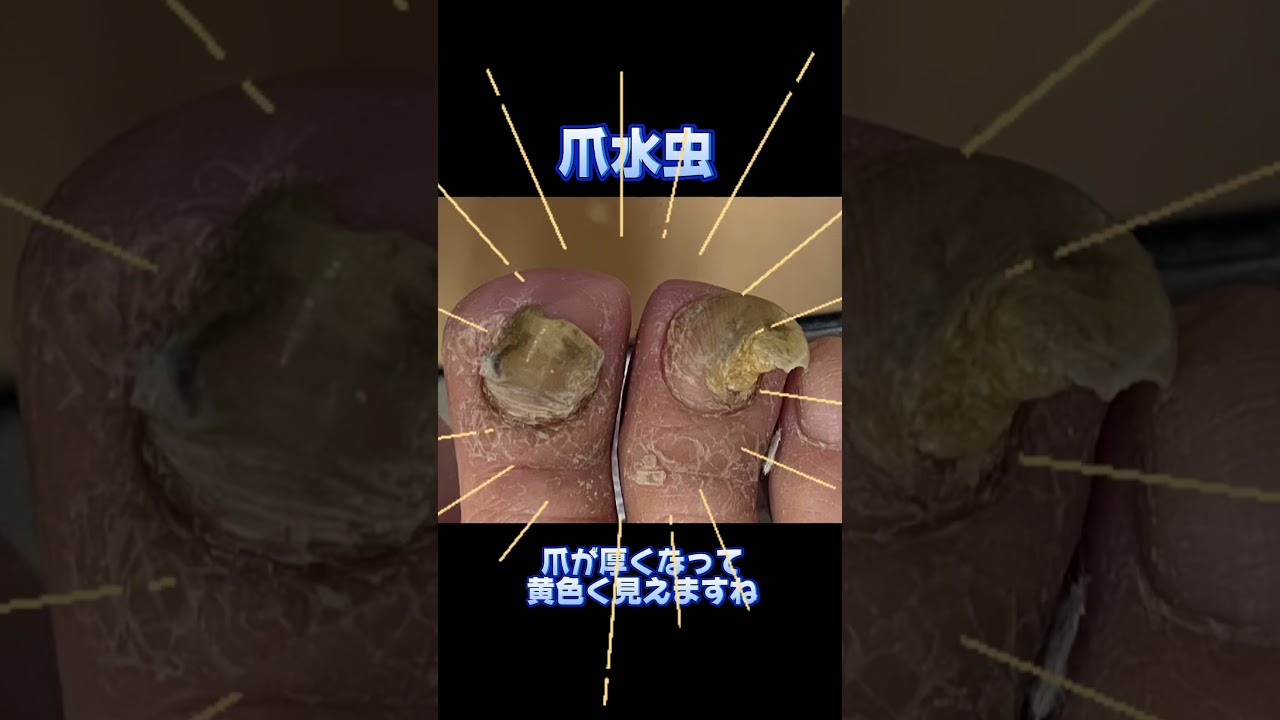 爪水虫！削ると早く治ります！#爪水虫 #爪水虫の治し方 #爪削り #水虫 #水虫爪 #厚い爪 #肥厚爪 #皮膚科 #美容皮膚科 #こはく皮フ科クリニック #こはく皮膚科クリニック #豊田市に開業予定