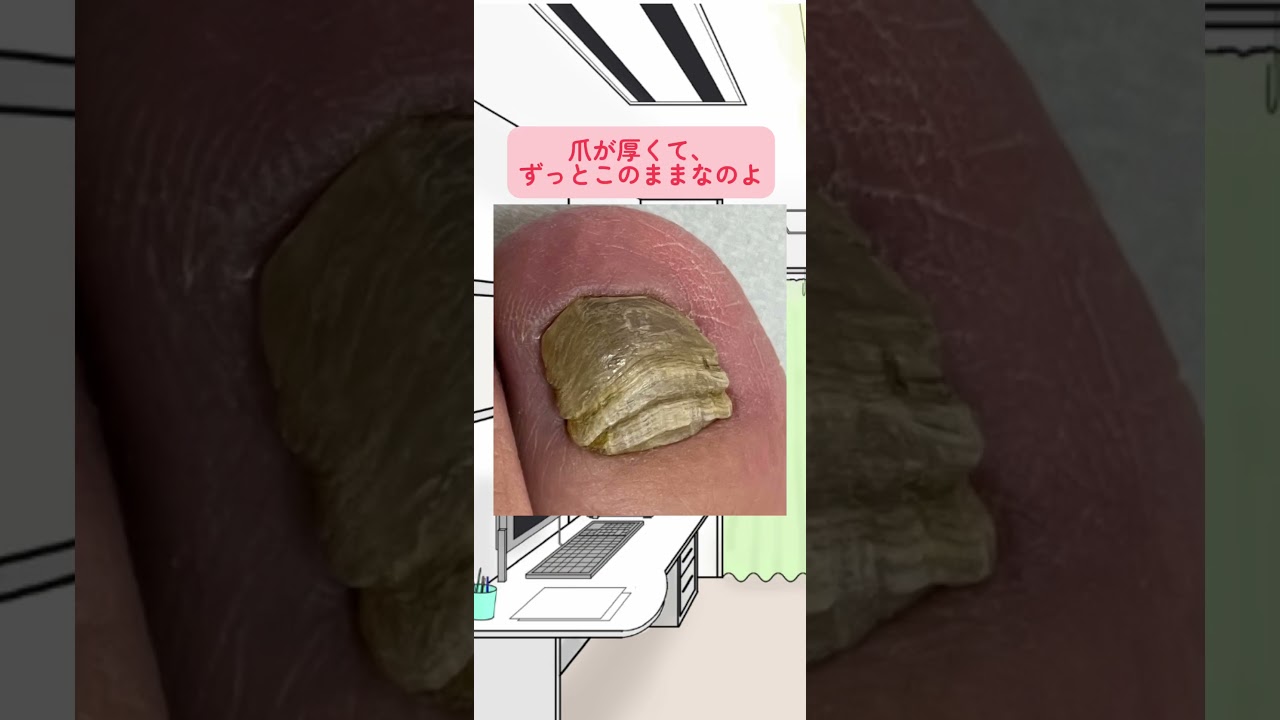 爪水虫の薬が効かない！#爪水虫 #水虫 #爪 #水虫 #水虫じゃなかった #爪が厚い #爪の形 #薬 #飲み薬 #爪甲鉤彎症 #皮膚科 #美容皮膚科 #こはく皮フ科クリニック #こはく皮膚科クリニック