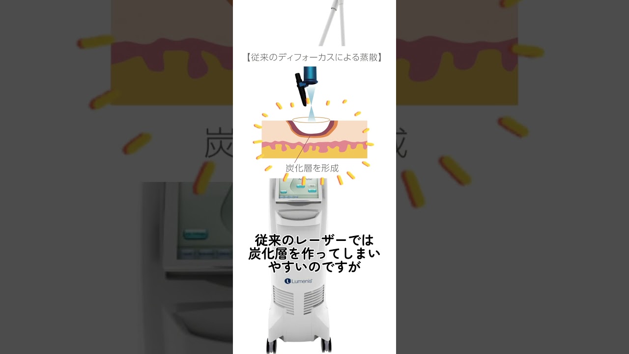 アキュパルス！#アキュパルス #ルミナス #acupulse #lumenis #イボ #いぼ #イボ取り #ほくろ #ほくろ除去 #皮膚科 #美容皮膚科 #こはく皮フ科クリニック #豊田市に開業予定