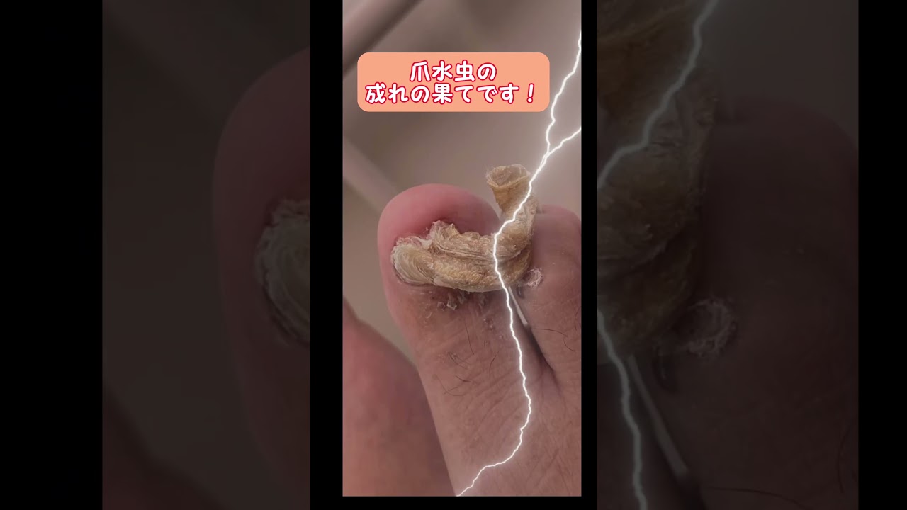 伸び切った肥厚爪、爪水虫にお悩みの方、こはく皮フ科クリニックでキレイにできます