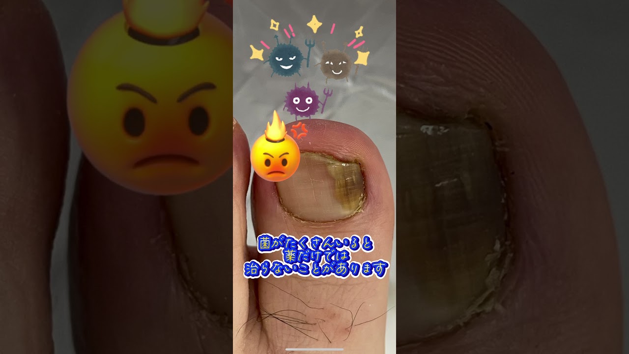 削って治そう！爪水虫！#爪水虫 #爪水虫の治し方 #爪削り #グラインダー #爪白癬 #爪白癬ケア #白癬 #水虫 #皮膚科 #美容皮膚科 #こはく皮フ科クリニック #こはく皮膚科クリニック